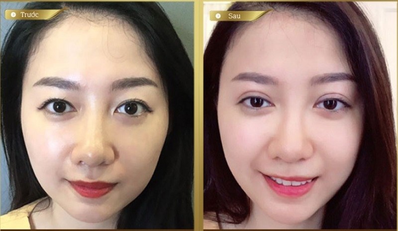 Rất nhiều chị em lựa chọn thực hiện cắt mí