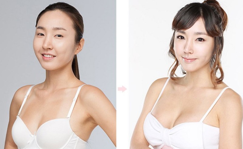 Quy trình nâng ngực được thực hiện chuẩn y khoa