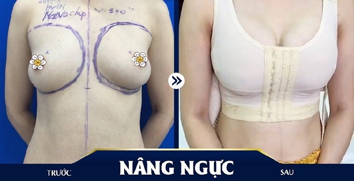 Nâng Ngực Ở Đâu Đẹp? Top 13 Địa Chỉ Thẩm Mỹ Vòng 1 Tốt Nhất