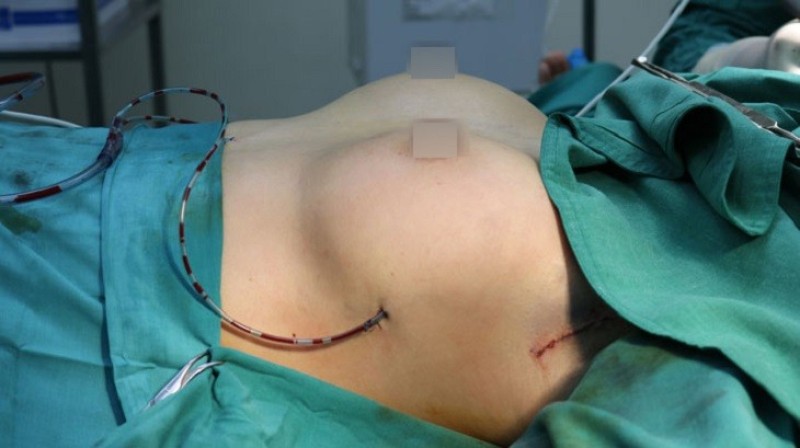 Nâng ngực tại bệnh viện Trung ương Quân Đội 108