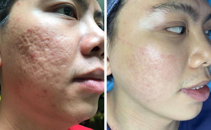 Top 9 Thẩm Mỹ Viện Trị Sẹo Trắng Uy Tín Chất Lượng Nhất