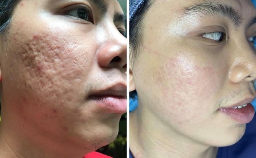 Top 9 Thẩm Mỹ Viện Trị Sẹo Trắng Uy Tín Chất Lượng Nhất