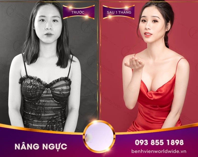 Khách hàng sau khi nâng ngực tại bệnh viện