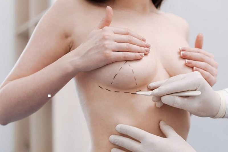 Tăng vòng 1 sau cai sữa bằng phương pháp thẩm mỹ