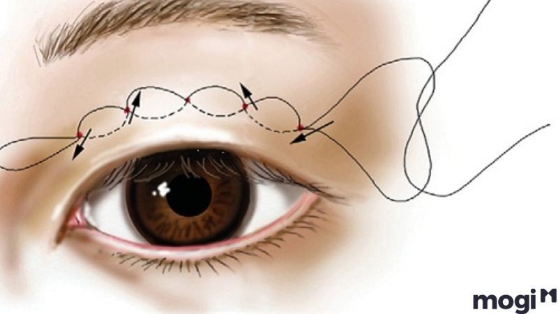 Mắt tam bạch là gì? Có thay đổi được không?