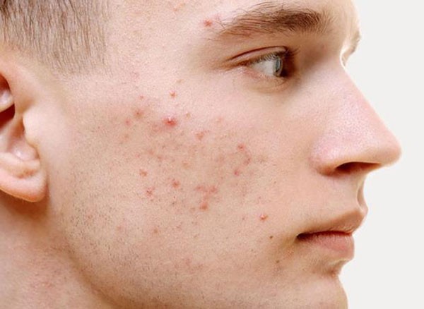 7 Bước Nặn Mụn Đúng Cách, Đảm Bảo Không Để Lại Thâm, Sẹo Rỗ