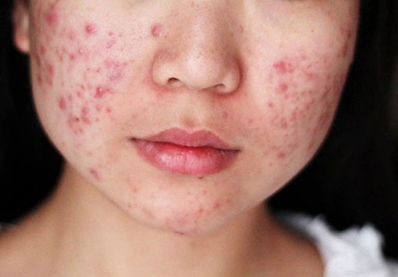 Mụn viêm không xử lý đúng cách sẽ để lại sẹo rỗ.