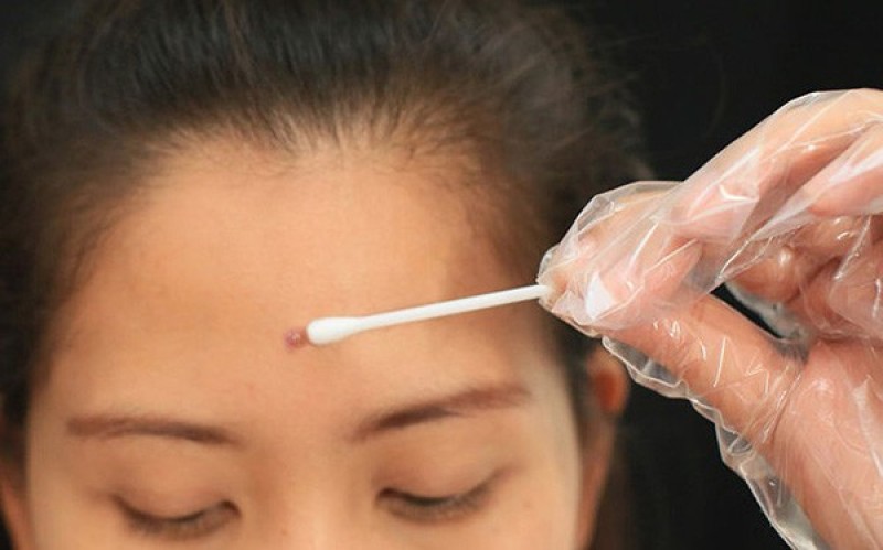 Dùng tăm bông để lấy nhân mụn sau khi nặn.
