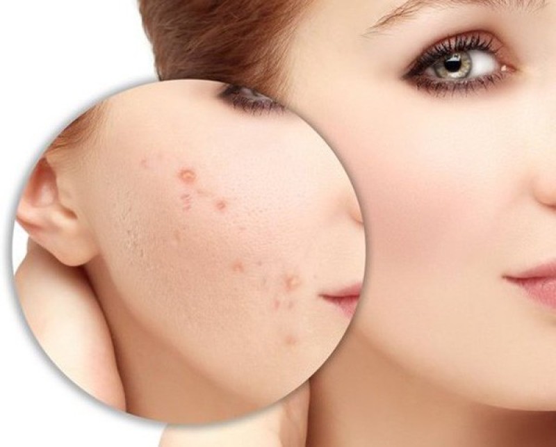 Những bạn đang gặp vấn đề mụn nên sử dụng AHA.