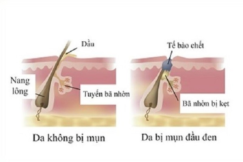 Sự hình thành mụn đầu đen được xuất phát từ việc không tẩy tế bào chết.