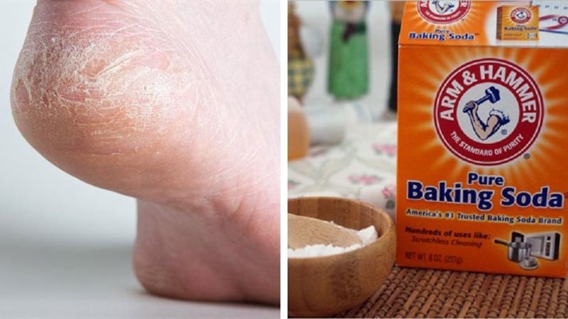 Trị nứt gót chân bằng baking soda