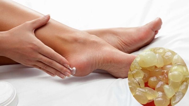 Trị nứt gót chân bằng mỡ trăn
