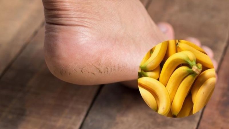 Trị nứt gót chân bằng chuối