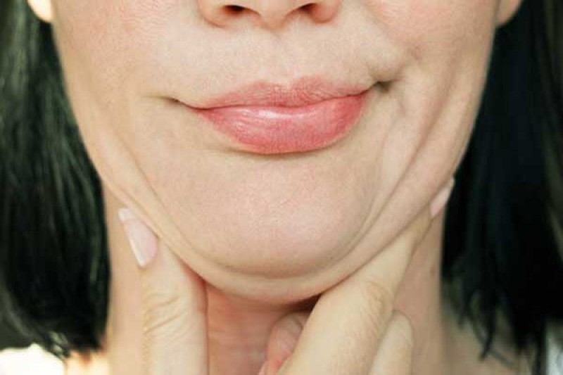 Nhiều người gặp tình trạng giảm cân nhưng vẫn béo mặt