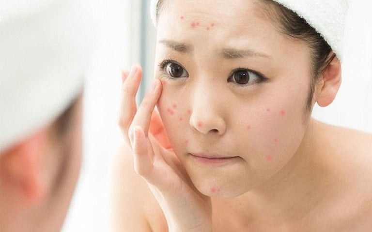 Mẹo Trị Mụn Do Ăn Nhiều Thức Ăn Ngọt Với Các Nguyên Liệu Thiên Nhiên