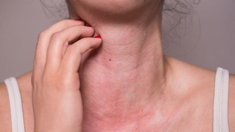Phát hiện những thực phẩm gây dị ứng