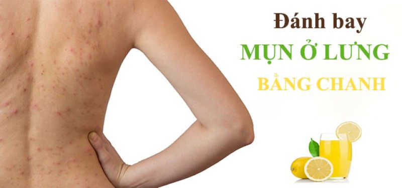 Mẹo trị mụn ở lưng cho nam giới bằng chanh