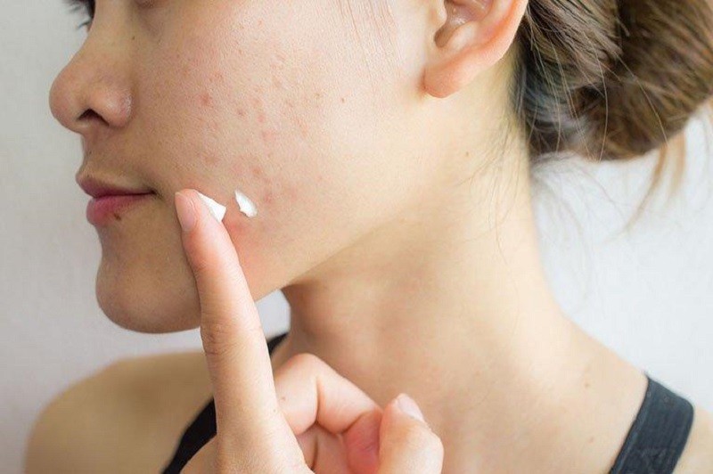 Sử dụng sản phẩm đặc trị mụn phù hợp sau khi tẩy trang