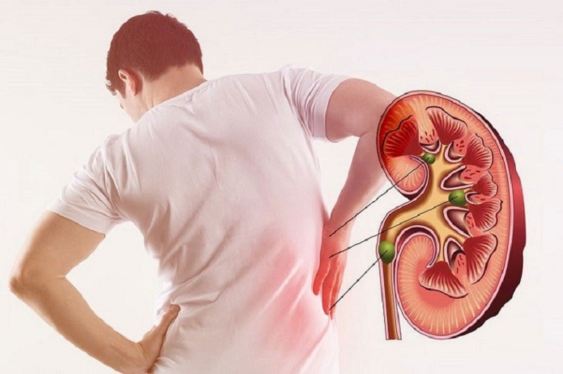 Những người đang mắc phải các bệnh về thận thì không nên áp dụng